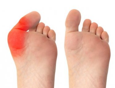 足立区北千住で足の指の痛みを伴う外反母趾の改善 予防法なら 北千住中央整骨院